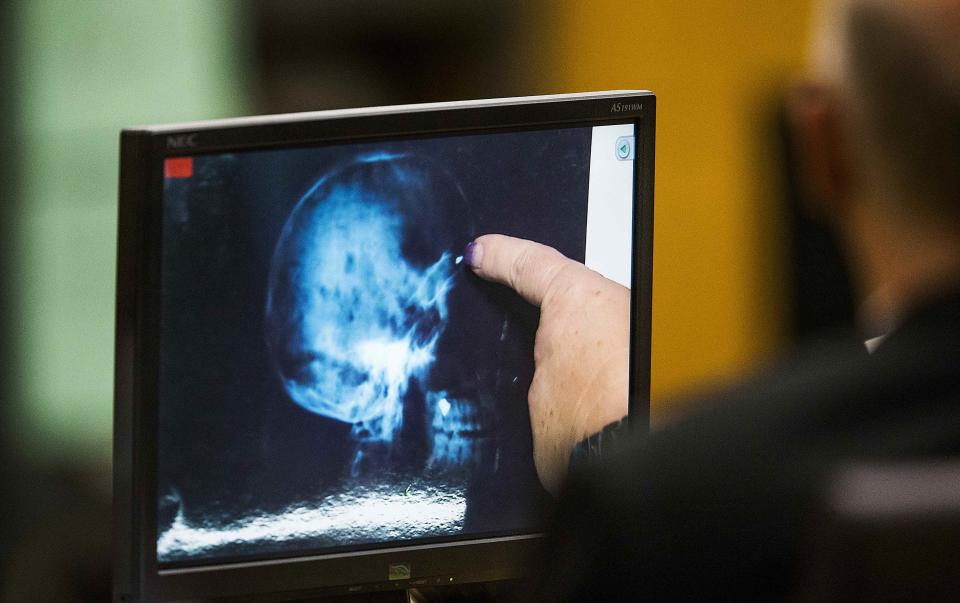 An x-ray of Travis Alexander's skull is used in the Maricopa County Superior Court room of Judge Sherry Stephens in Phoenix, Arizona, October 22, 2014. An Arizona jury was sworn in on Tuesday to decide whether Jodi Arias, who was convicted of the 2008 slaying of her ex-boyfriend at a sensational trial, should face the death penalty or life in prison. (REUTERS/Tom Tingle/The Arizona Republic/Pool)