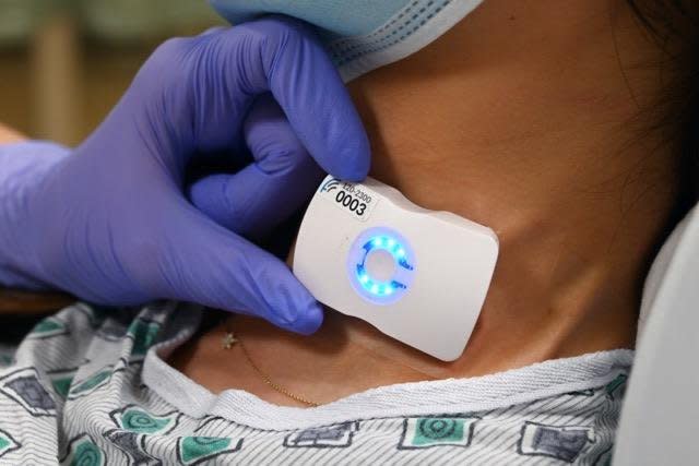 FloPatch is the world's first wireless,
wearable Doppler ultrasound system
that is placed on a patient’s neck. El
Camino Health is the first health
system in the world to adopt the
device, which helps clinicians better
manage intravenous fluid therapy
earlier in the sepsis care pathway. Photo courtesy of El Camino Health