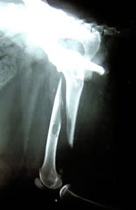 X-ray of broken leg