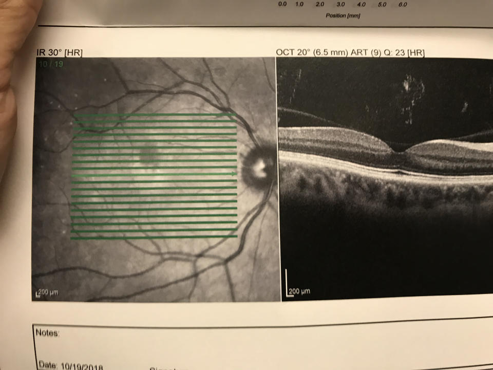 An OCT of the writer's eye showed the oval gray area where the embolism was lodged, cutting oxygen off from that part of her retina. (Photo courtesy of Anna De Souza)