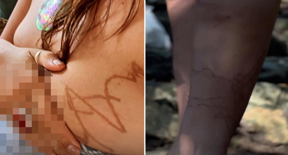 Zoe Cahill's scars from the box jellyfish on her chest and legs. 