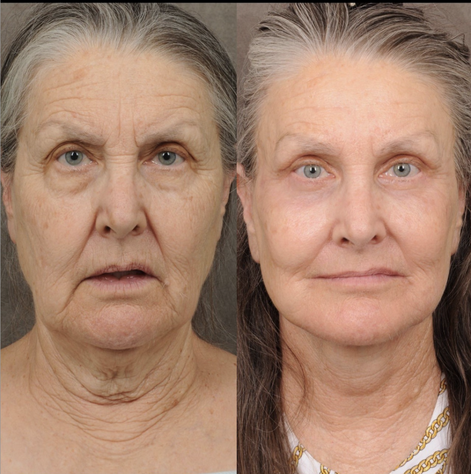 Auralyft Patient - Before and After Photos - Dr Ben Talei