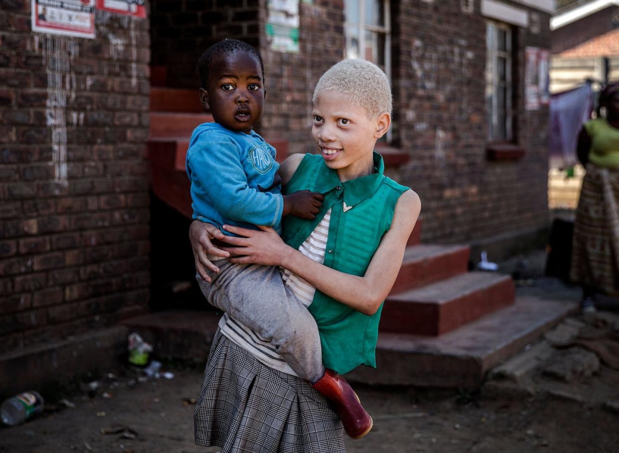 An albino girl carries a member of her family in Zimbabwe. <span>Luis Tato/AFP via Getty Images</span>