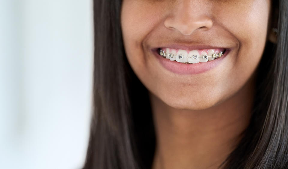 A close-up of a smiling person wearing braces