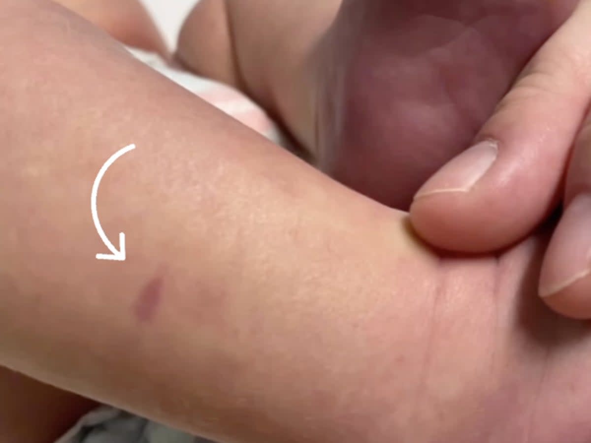 The new mum first noticed the small mark did not turn white when she applied pressure  (Instagram @tinyheartseducation)
