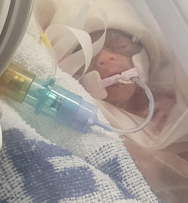 babies born at 15 weeks