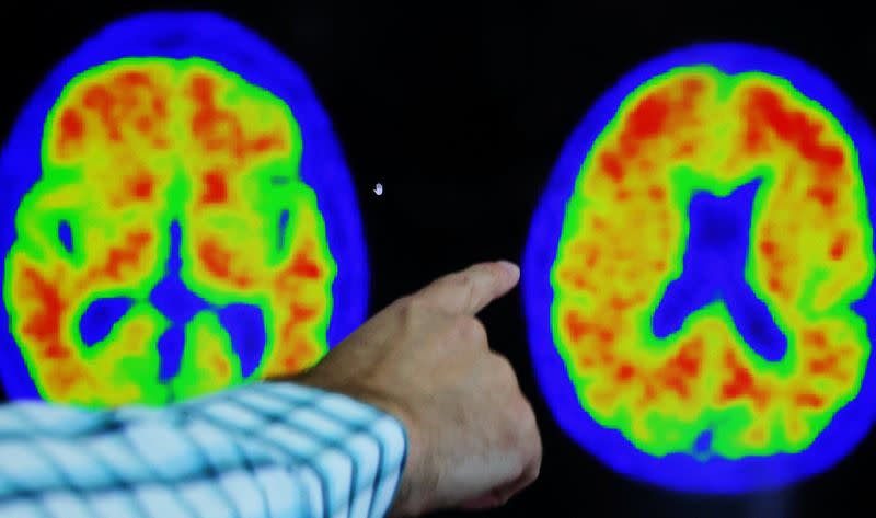 Evidence of Alzheimer’s disease on PET scans at the Center for Alzheimer Research and Treatment in Boston