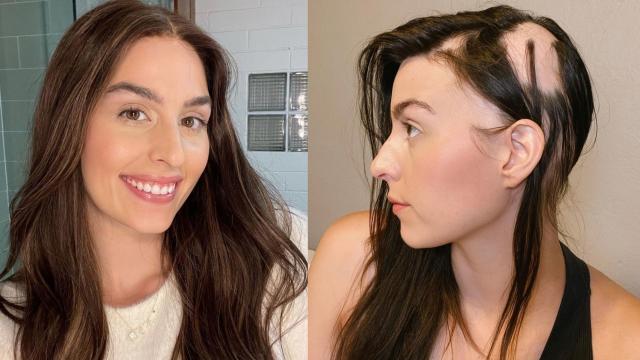 Robyn Germyn: Influencer's candid message about alopecia aereata goes viral