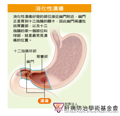 消化性潰瘍好發的部位接近幽門附近,幽門正是胃到十二指腸的關卡,因此幽門兩邊包括胃竇部,以及十二指腸的第一個部位叫球部,就是最常見潰瘍的位置。