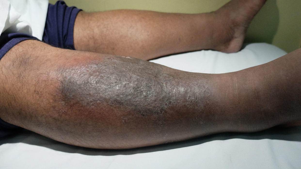 A patient who developed cellulitis and a blood clot in the leg. (Casa nayafana / Shutterstock)
