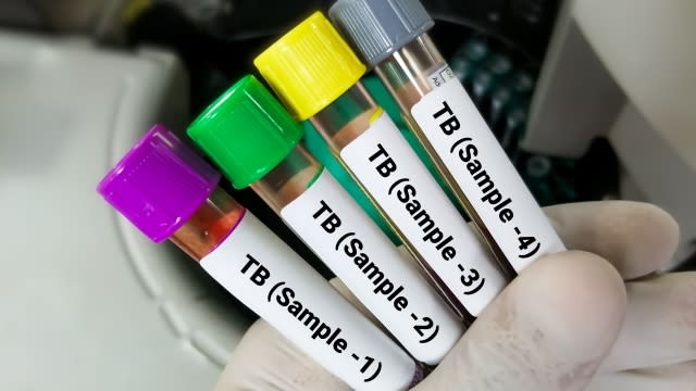 A hand shown in a medical glove holds TB test samples