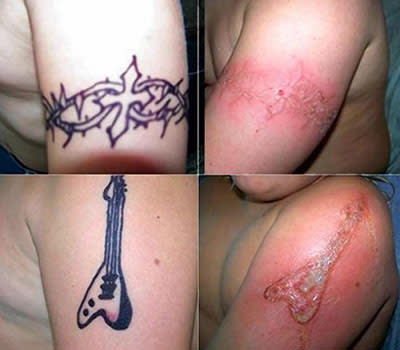 Diese Ekzeme (r.) sind Folge von Black-Henna-Tattoos (Bild: www.doh.state.fl.us)