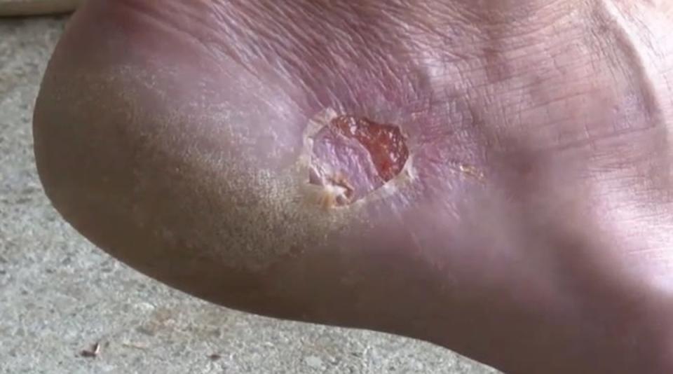 The foot was infected with vibriosis (WCIV)