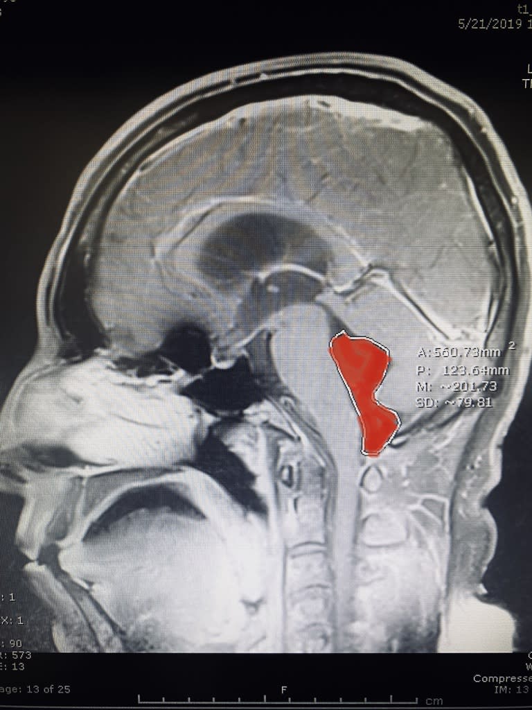 Texas doctors removed a tapeworm from a man's brain, which they called life-threatening. (Photo: Ascension Health)