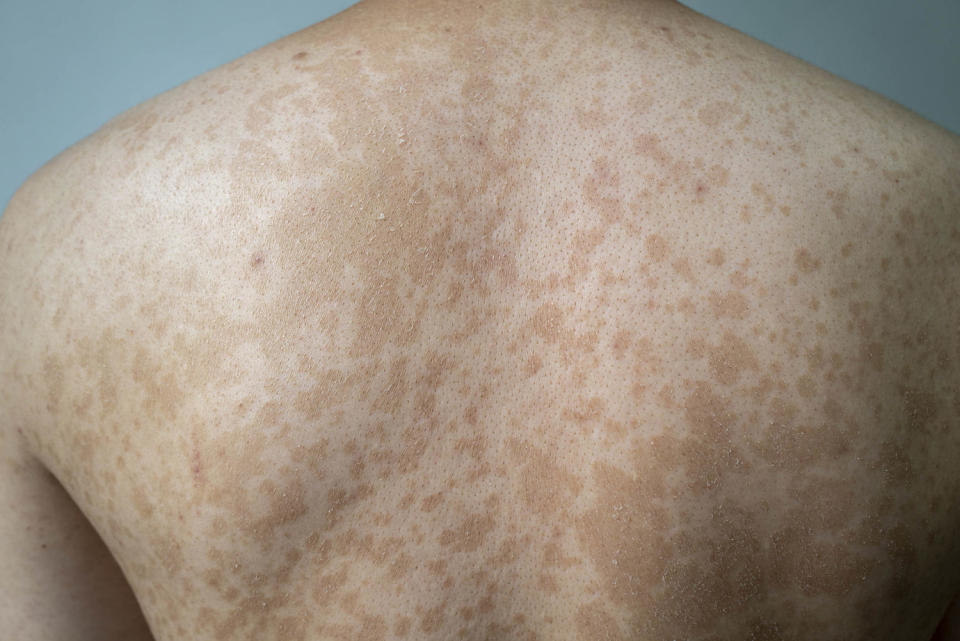 Tinea versicolor (HengDao / Getty Images)