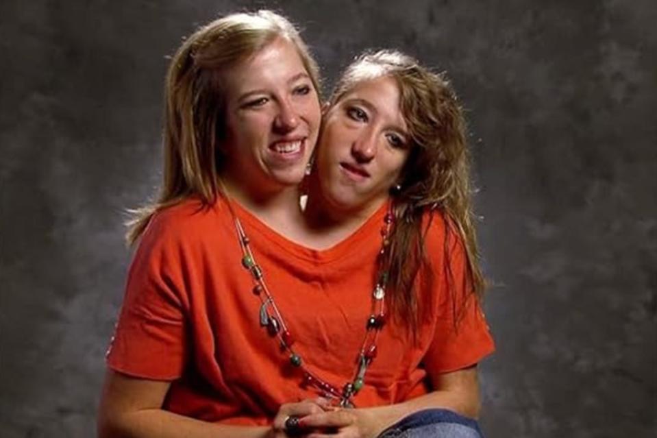 Abby and Brittany in their younger days. They are now 34. TLC