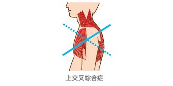 上交叉綜合症圖解。（圖片提供／三采文化）