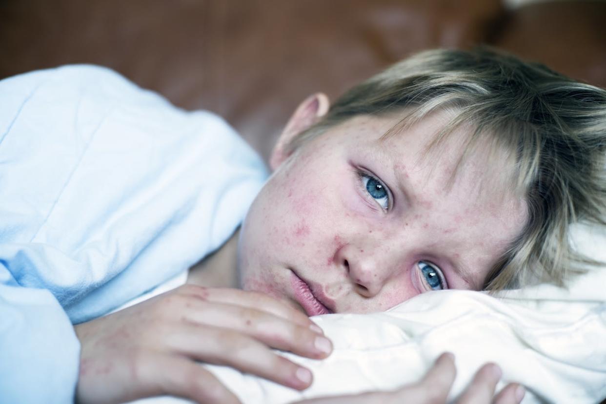 Young children, pregnant people and the immunocompromised are among the most vulnerable to measles. <a href="https://www.gettyimages.com/detail/photo/measles-royalty-free-image/534079149" rel="nofollow noopener" target="_blank" data-ylk="slk:CHBD/E+ via Getty Images;elm:context_link;itc:0;sec:content-canvas" class="link ">CHBD/E+ via Getty Images</a>