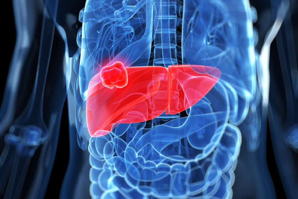 Liver cancer, computer artwork.