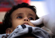 <p>A Yemeni child suspected of being infected with cholera receives treatment at a makeshift hospital in Sana’a on June 5, 2017.<br> Yemen is descending into total collapse, its people facing war, famine and a deadly outbreak of cholera, as the world watches, the UN aid chief said. (AFP/Getty Images) </p>