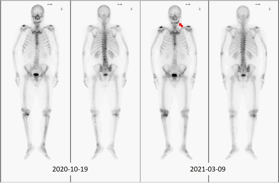 今年3月的骨骼掃描中，發現左下顎出現新增的放射活性增加的病灶（右側紅色箭頭指處）