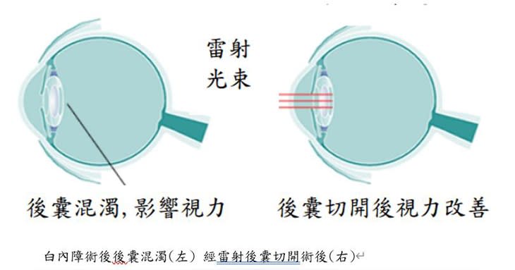 白內障術後後囊混濁(左) 經雷射後囊切開術後(右)（圖片提供／亞東醫院）