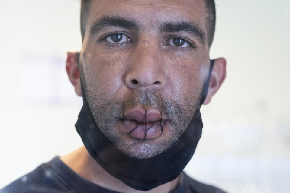 A man from Algeria, no name given, with his lips sewn together and on hunger strike poses for a photo as he occupies with others a big room of the ULB Francophone university in Brussels, Tuesday, June 29, 2021. (AP Photo/Francisco Seco)