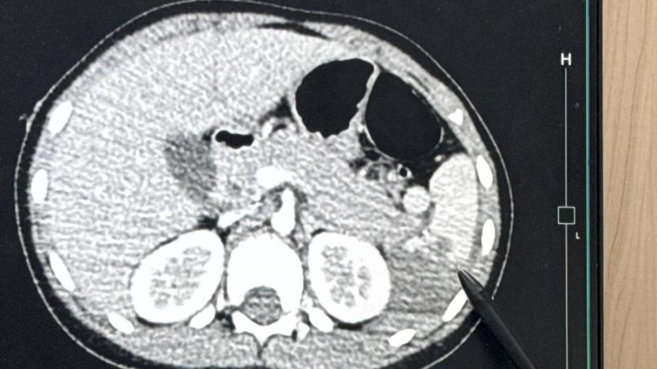 6歲女童站機車踏板上遇車禍，脾臟破裂切除3分之2。（圖／李綜合醫院提供）