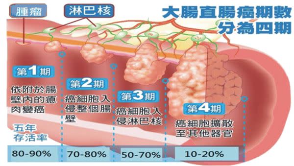 大腸直腸癌期數分為四期。（圖片／謝佩穎醫師提供）