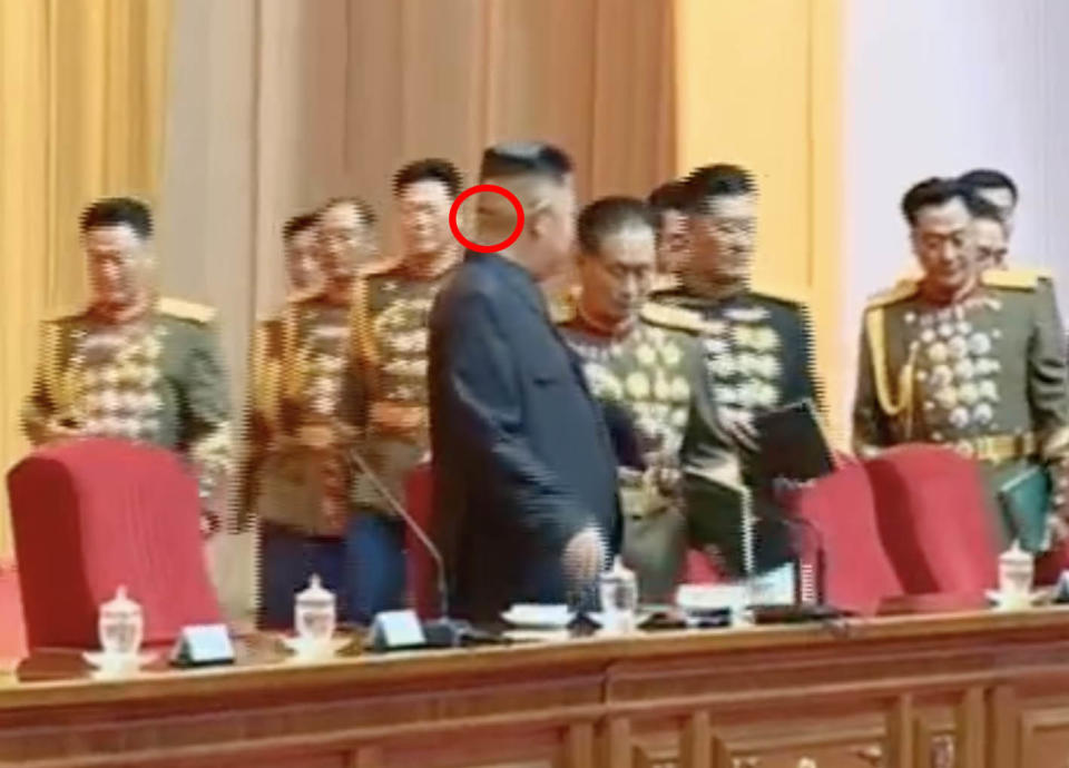 A mysterious head wound fuelled further speculation about Kim Jong-un's health. Source: KCTC