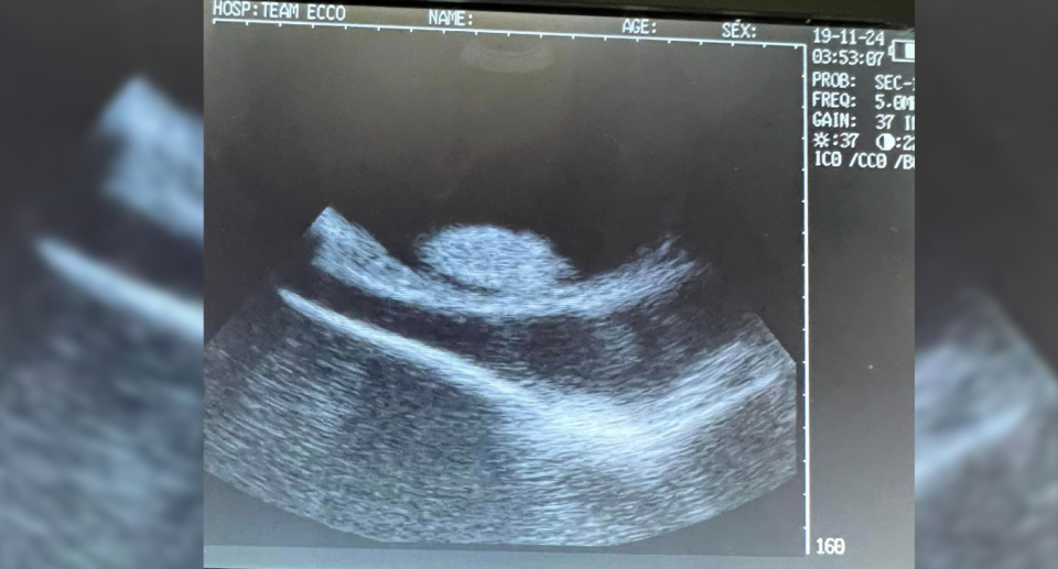 The ultrasound shows a bump in the stingray's abdomen. 