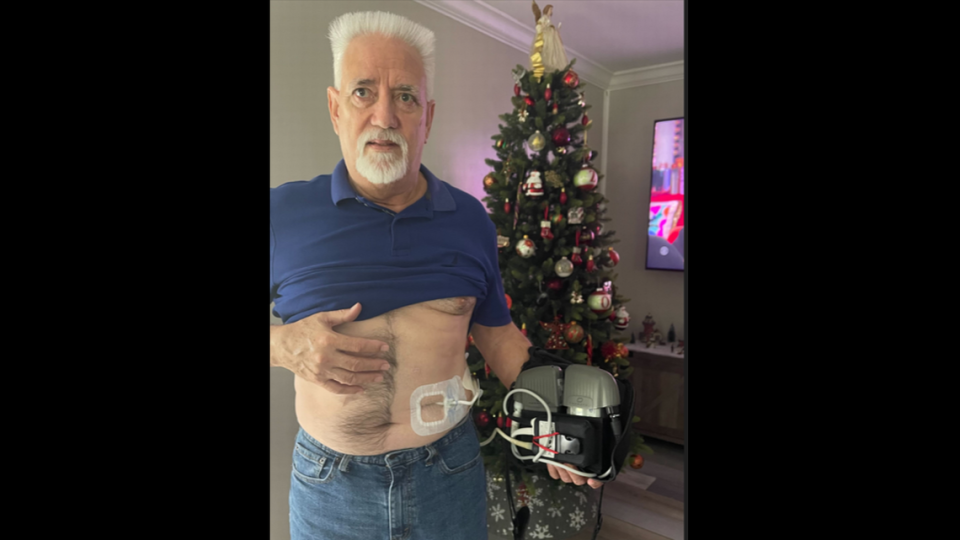 Juan Llanes’ doctors implanted a left ventricular assist device, or heart pump, into his chest to boost his survival chances while he waits for a heart transplant at the Miami Transplant Institute at Jackson Memorial Hospital. In mid-March, the institute suspended its adult heart transplants.