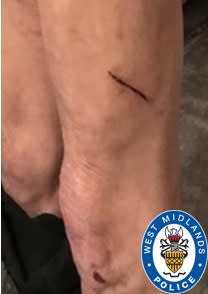 Photos show the victim's injuries as police appeal for information. (West Midlands Police)