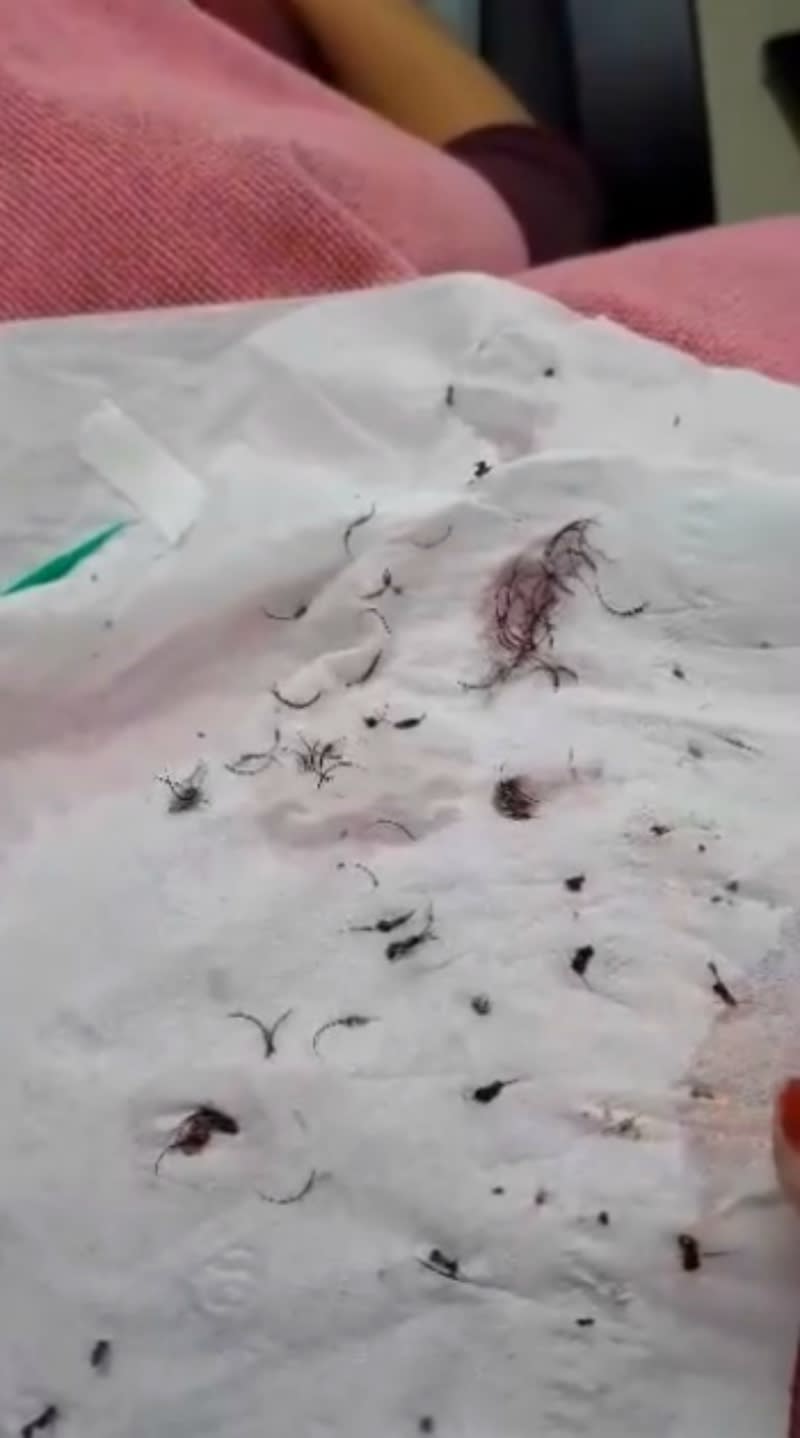 The remnants left over after the removal of the botched eyelash extensions. [Photo: Facebook/Fara Beautysalon]