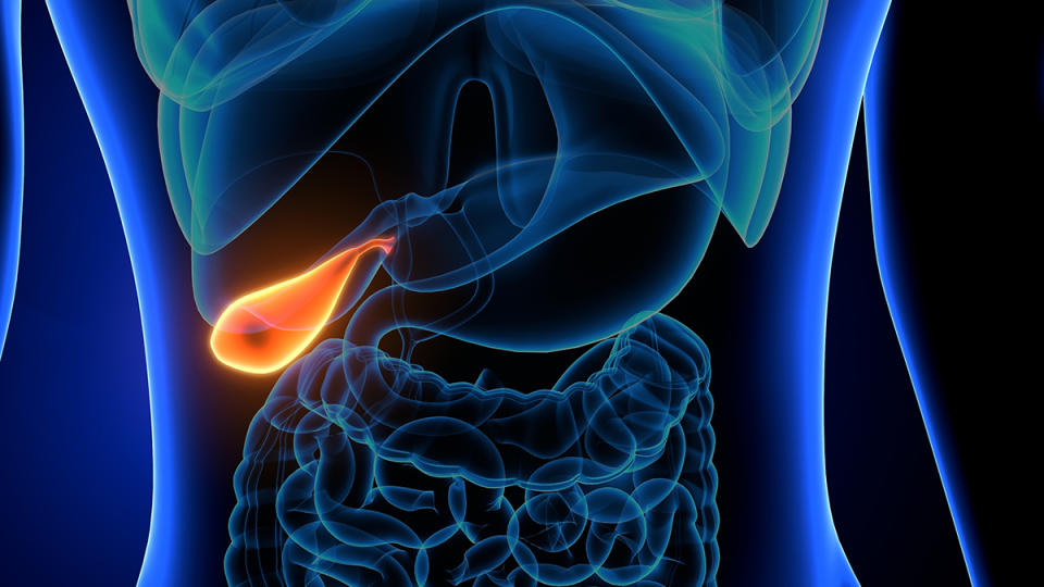 A gallbladder inflammed by the presence of a gallstoone
