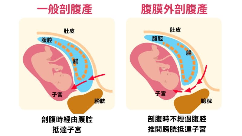 <strong>腹膜內剖腹產（左）就像是走雪隧，除非雪隧全塞住，不然不會繞道走省道。（圖／台灣女人連線提供）</strong>