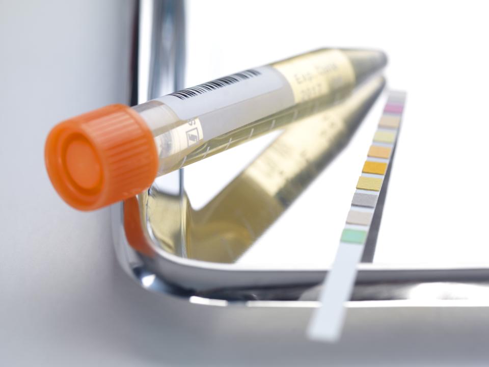 Urine analysis. Urine sample with a test strip showing the results. Urine analysis is used to test for diabetes, kidney problems and urinary tract infections.