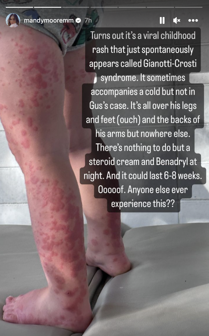 An up close shot of a young boy's legs covered in red splotches (Mandy Moore / Instagram)