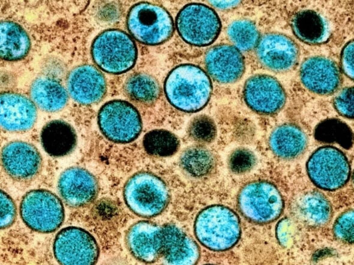 Mpox burst onto the global landscape in 2022, spreading to dozens of countries through sexual networks that largely impacted men who have sex with men. Infections can lead to painful lesions and, in more severe cases, sepsis, lung nodules and even death. (National Institute of Allergy and Infectious Diseases - image credit)