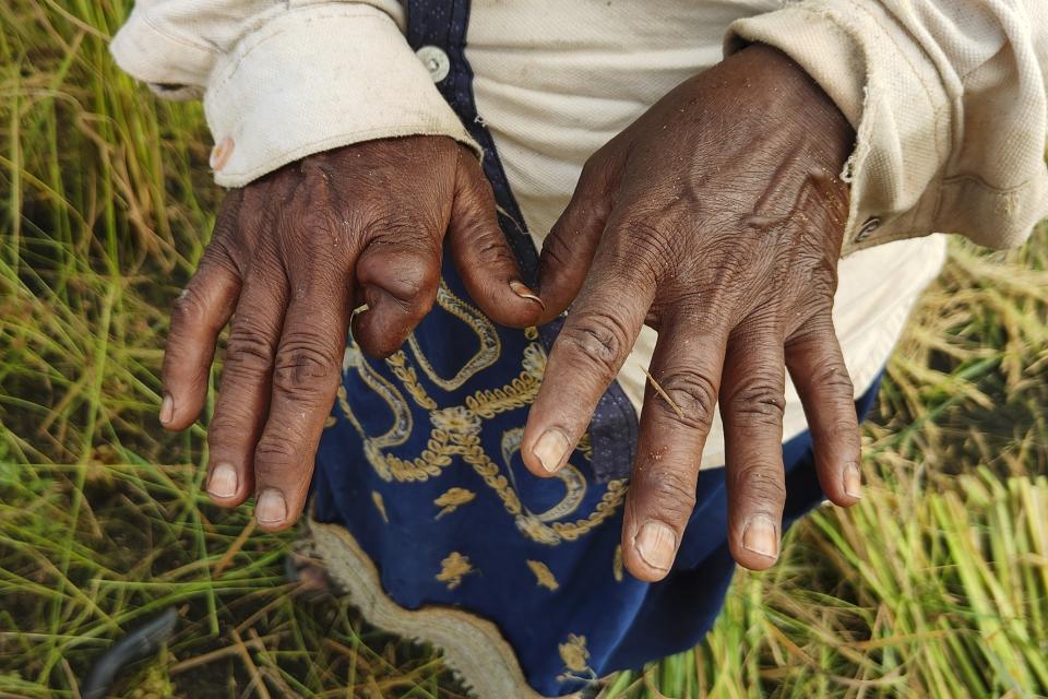 Savita Singh lost a finger to a chemical infection that she got after spraying pesticides and insecticides on a farm in Nanu village of Aligarh district in Uttar Pradesh state, India, on Oct. 17, 2023. She blames climate change that required her to use much more of the chemicals to make up for declining yields. (Uzmi Athar/Press Trust of India via AP)