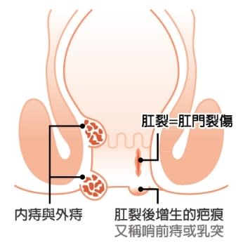 肛裂與痔瘡