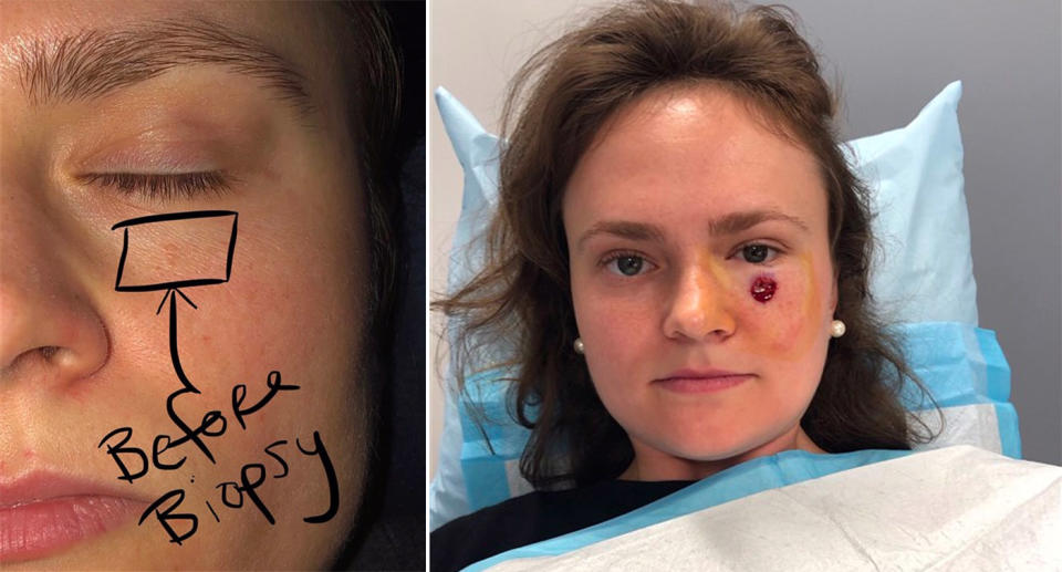 A split image showing Gibson Miller's skin cancer before and after surgery.