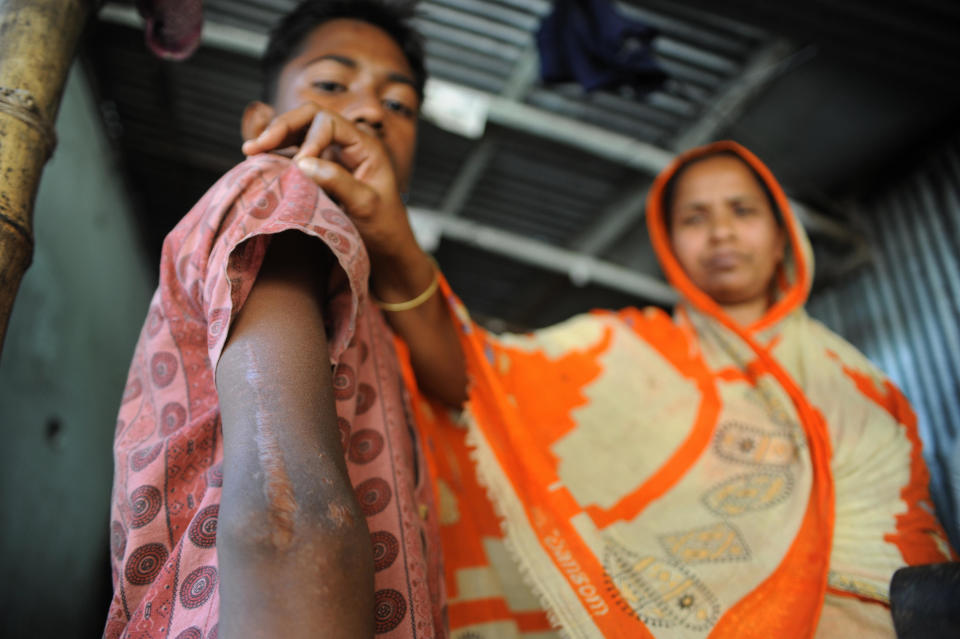 In this photograph taken on February 25, 2009 the mother of Bangladeshi youth Shamim Mia, who worked as a camel jockey in the United Arab Emirates (UAE), displays injuries sustained during his work in his house in Gazipur, some 50 kms from Dhaka. Hundreds of Bangladeshi children trafficked to the United Arab Emirates and forced to work as child jockeys are to get thousands of dollars in compensation from the desert state, an official said. Bangladesh's state minister for home affairs Tanjim Ahmed said a delegation from the UAE had arrived in the capital Dhaka and handed over a cheque for 1.43 million dollars to be given to 879 children. AFP PHOTO/Munir uz ZAMAN (Photo credit should read MUNIR UZ ZAMAN/AFP/Getty Images)