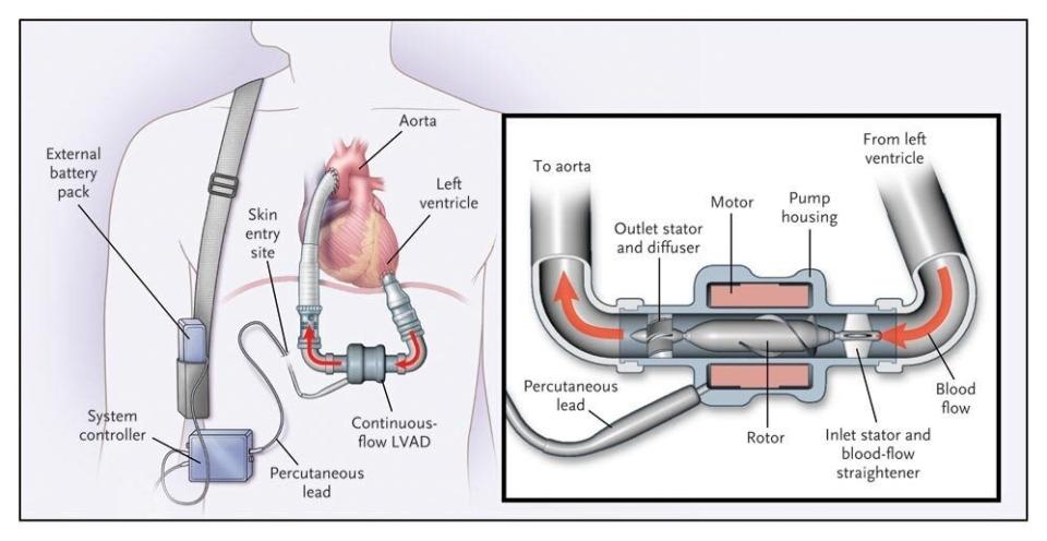 This diagram shows a left-ventricular assist device similar to those the Roman brothers use. (Photo: <a href="https://stanfordhealthcare.org/medical-treatments/l/lvad.html" target="_blank">Stanford Health Care</a>)