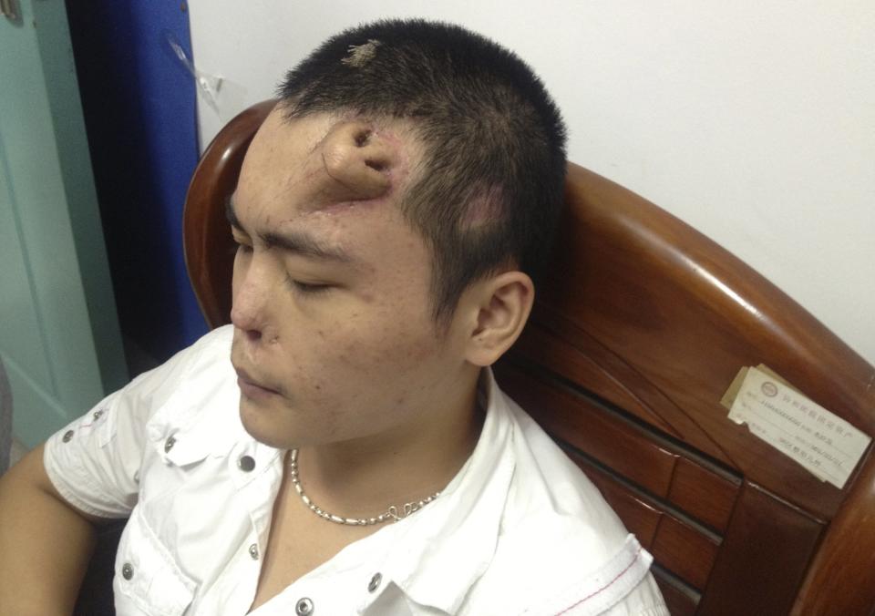 A new nose, grown by surgeons on Xiaolian's forehead, is pictured before being transplanted to replace the original nose, which is infected and deformed, at a hospital in Fuzhou