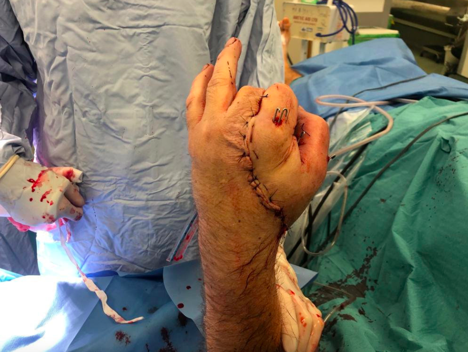 A man's hand was saved after it was sewed onto his groin (SWNS)