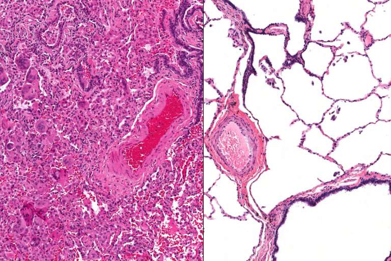 The patient's lung tissue under the microscope (left) and healthy lung tissue under the microscope (right): Kirk Jones, UCSF