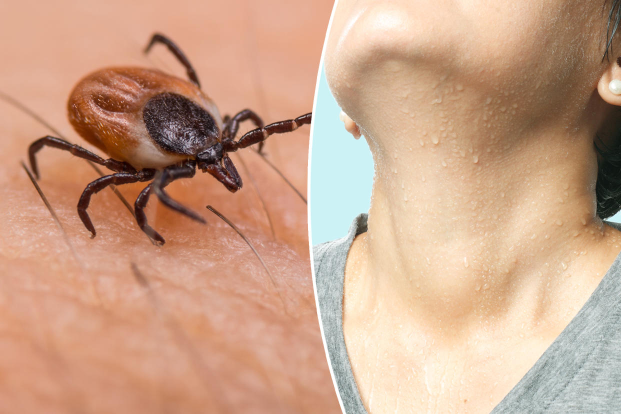Researchers at MIT and the University of Helsinki have determined that human sweat contains a protein that inhibits the growth of a bacterium that causes Lyme disease.