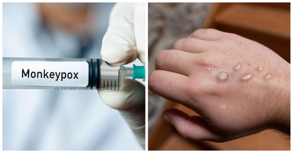 Monkeypox was declared by WHO as a public health emergency of international concern on 23 July 2022. (PHOTOS: Getty Images)