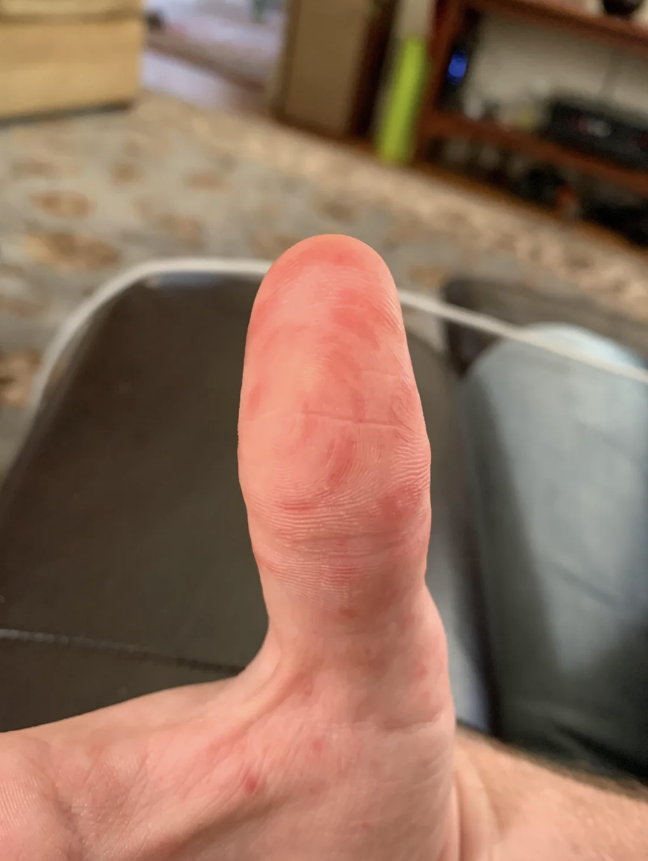 A close-up of a person's thumb held up, with household furniture blurred in the background. The skin on the thumb appears textured. Names unknown